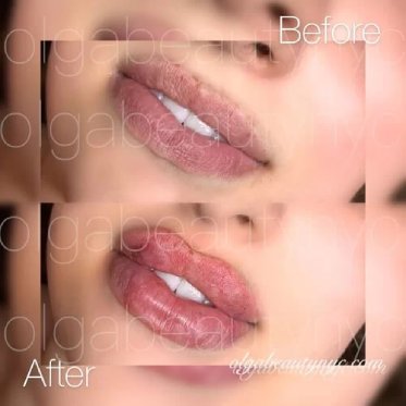 lip-augmentation