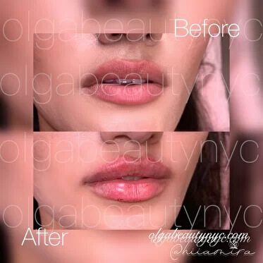 lip-augmentation