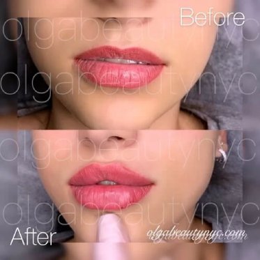 lip-augmentation